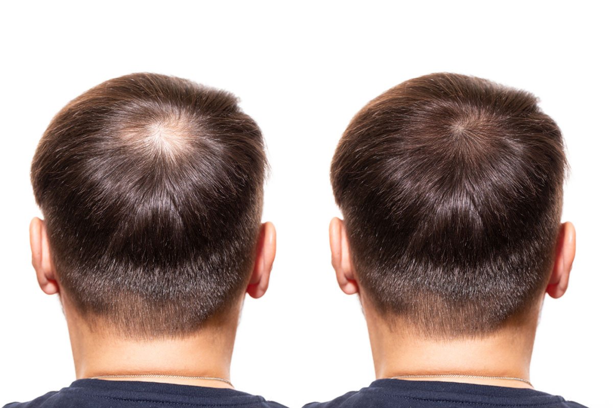 Hair Transplant UK – Trusted Nationwide Experts at Westminster Medical Group®