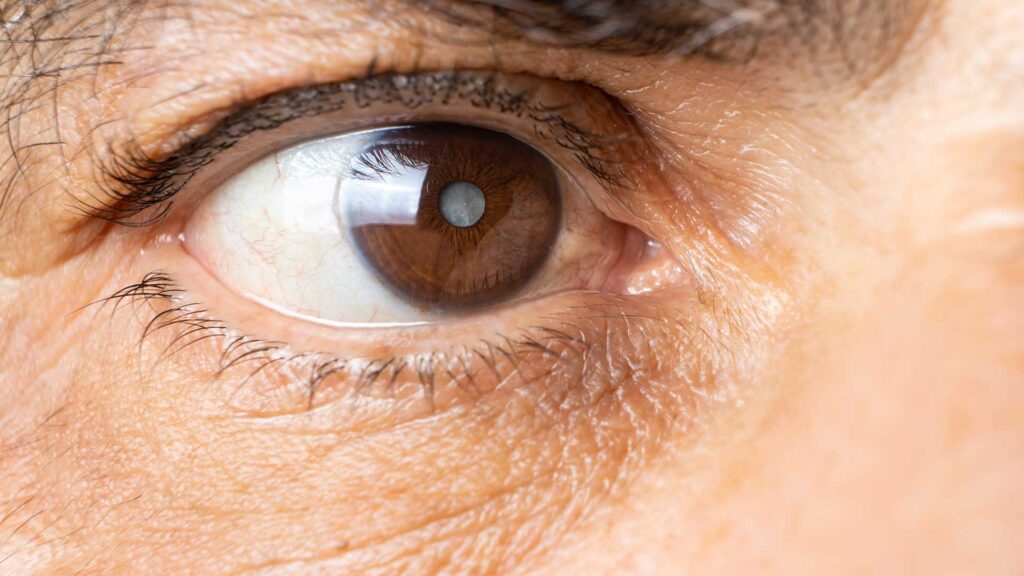 LASIK Turkey Packages: What’s Included?