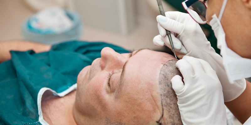 Hair Transplant Istanbul – Your Solution for Hair Loss