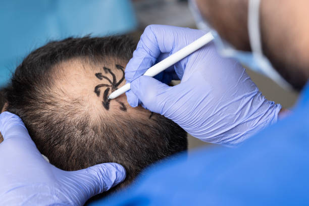 Hair Transplant Turkey Cost: Complete 2026 Price Guide